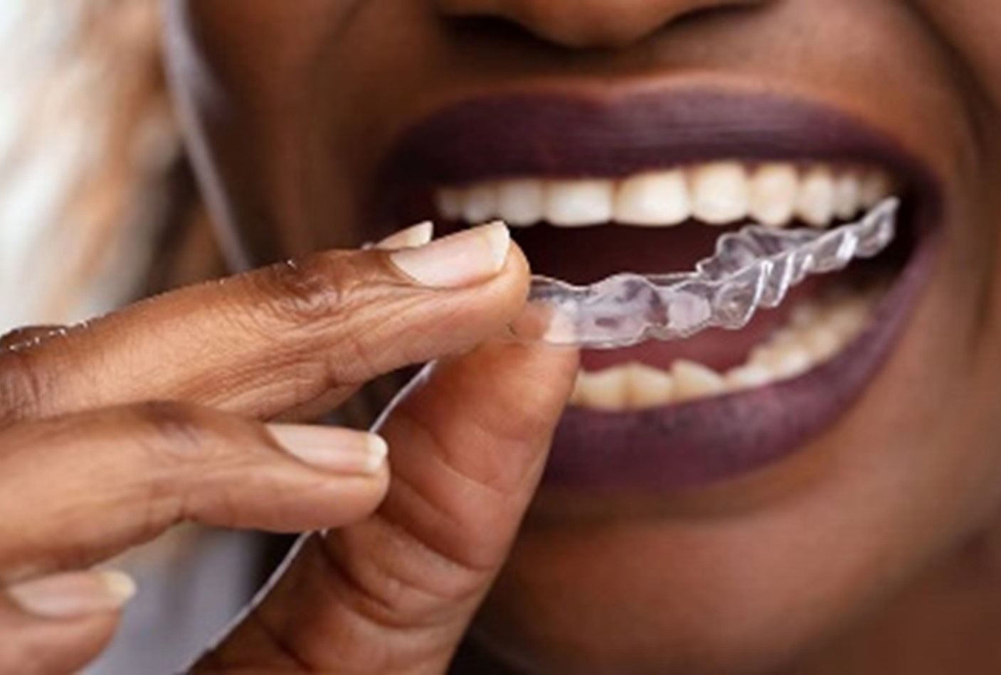 Clear Aligners Dentistry in Uganda