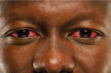 Infectious Conjunctivitis