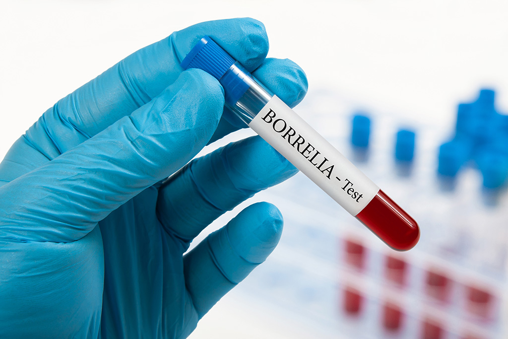 Borrelia test